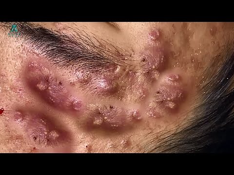 Big Cystic Acne Blackheads Extraction Blackheads & Milia, Whiteheads Removal Pimple Popping