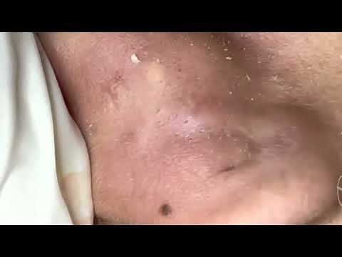 Blackheads Behind The Ear #blackheads #removal #pimple #acne #pimples