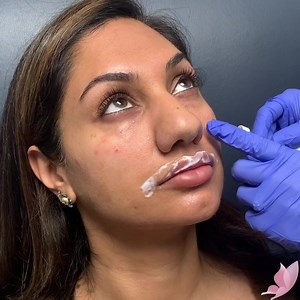 This beauty is saying bye bye to her dark circles 👏🏼 Our #teartrough treatment helps address hollowness that can be caused by genetics or aging and is a non-surgical treatment to help you look refreshed and youthful!🤩 We use topical numbing cream to numb the area first as featured! 🙌🏼 It can take a few weeks to settle for best results! Prices for this treatment start at $699! Results lasts up to 12 months 😍 | Beautologie Medical Group, Inc.