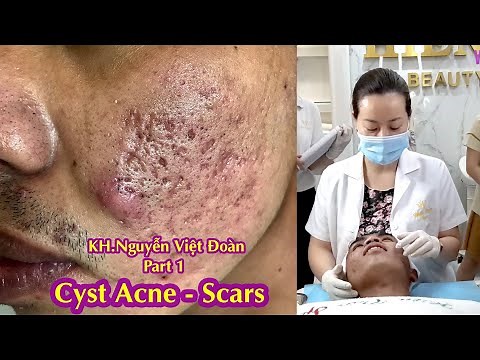 Cystic Acne Treatment I Điều trị mụn nang hiệu quả số 1 tại Hiền Vân Spa I Nguyễn Việt Đoàn I 510