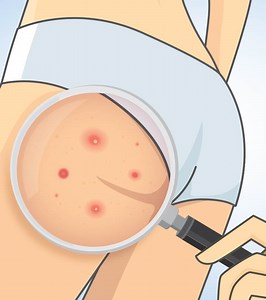 Home Remedies For Butt Acne: 11 Effective Solutions