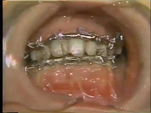 Ostectomy for Prognathism