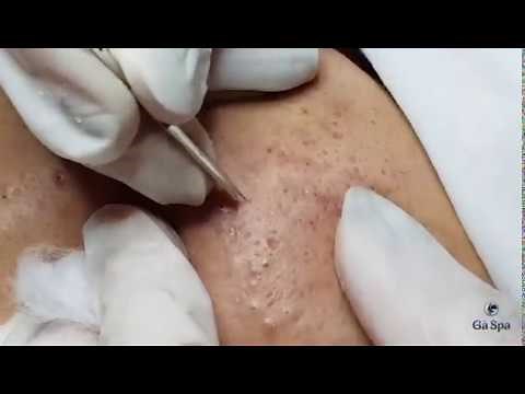 Acnes Treatment Service: Popping Blackhead Acnes Ver 2