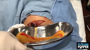 Dr. Pimple Popper removes disgusting cyst from patient's rear end