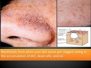 How To Get Rid of Blackheads On Nose Fast - Toothpaste ctto | Cruzifix Lee | Facebook