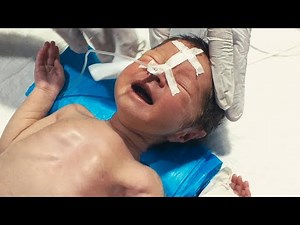 How We Insert NJ Tube & Give Feeding to Premature Baby in NICU | Step-by-Step Neonatal Care