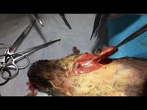 唾液腺切除方法について Madibular Sialadenectomy