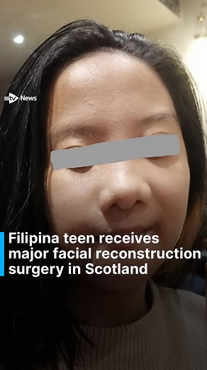Filipina teen receives major facial reconstruction surgery in Scotland | STV News