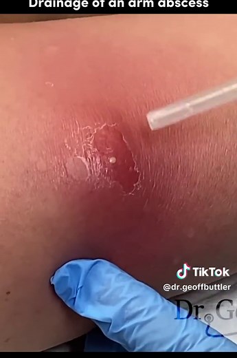 How to Drain a Grease Abscess | Acne Pimple Pop | Satisfying Video
