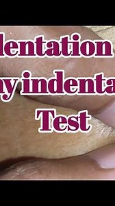Indentation and Bony Indentation Test (sebaceous cyst) । Examination of Swelling