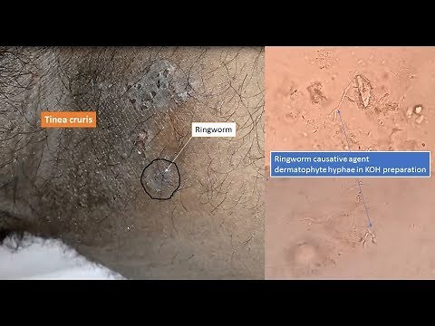 Ringworm and its causative agent dermatophyte under microscope