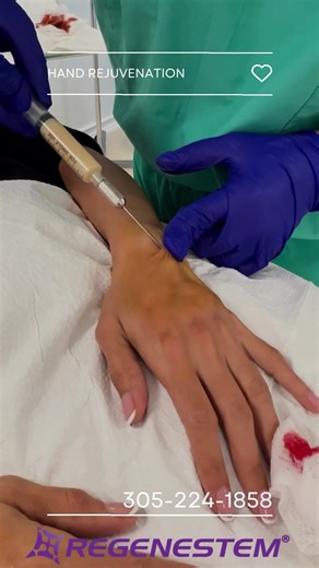 Matrix Biogel! 🫱 We generate a scaffold using platelet rich plasma. It is injected to achieve a filling effect and deep hydration of the skin! The hand rejuvenation 👐 is one of the most sought after procedures, and gives outstanding results! Call 📞 NOW for your FREE Consultation! 👉305-224-1858 www.regenestem.com #handrejuvenationtreatment #regenestem #regenerativemedicine #matrixbiogel #prp #gel #regeneration #fillers | Regenestem