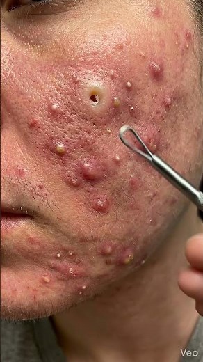 Extreme Acne Extraction – Pus-Filled Pimples Removed Close-Up 😬