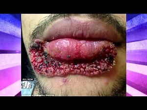 Find out Why You Should Think Twice about Popping That Zit!