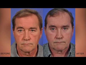 Fixing Festoons | W Cosmetic Surgery