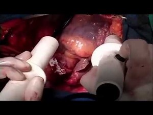 How Surgeons Make a New Heart Beat