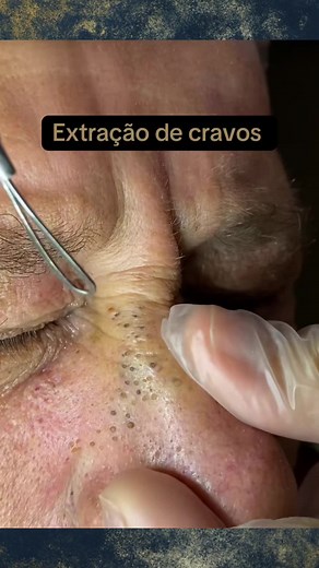 Extração Satisfatória de Cravos do Nariz