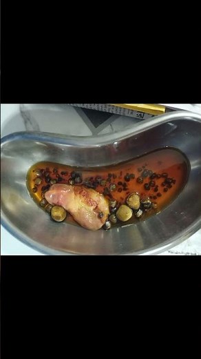 Gall bladder Stone | Laparoscopic Cholecystectomy |Open Cholecystectomy