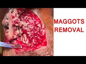 Maggots Removal | Diabetic Foot Case Before After