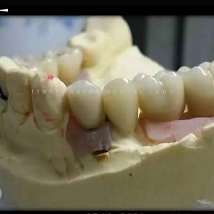 [Hot Item] High Strength Zirconia Crown Screwed for Implant Dentures En China Dental Lab