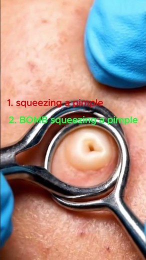 Huge Cyst Explosion! 💥 Satisfying Pimple Popping by Doctor #shorts