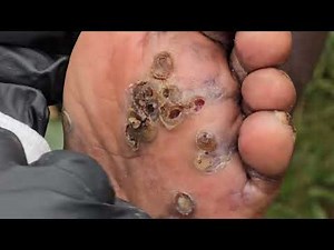 Fearful Tom Ojina jigger dug - see long video @ riseupsociety.net & ruskenya.org