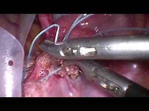 Laparoscopic Ventral Mesh Rectopexy after Hysteropexy