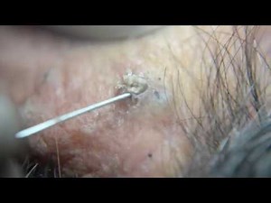 Ear Blackheads deep - removal