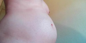 Bloated belly farts and burps (Pre-p*op)