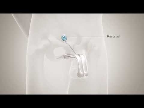 Inflating and Deflating the Titan Implant