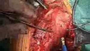 limb sparing proximal humerus