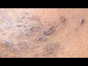 INGROWN HAIR REMOVAL #134 - PLUCKING SHORT ASHY INGROWN HAIRS