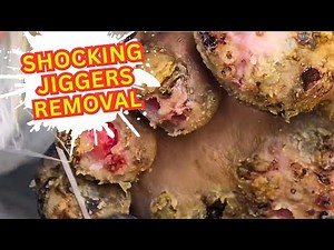 this will shock you! the most intense jigger removal ever caught on camera