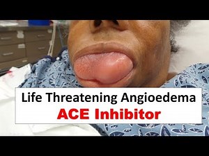 Life Threatening ACE Inhibitor Induced Angioedema