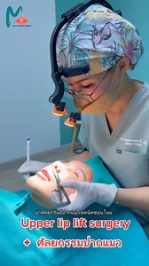 Bullhorn lip lift (Upper lip lift surgery) หลังทำทันที - หลังทำ 10...