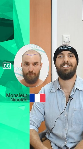 L’opération de transplantation capillaire de Monsieur Nicolas. Il est originaire de France. Il nous choisit pour la transplantation capillaire ! #transplantationcapillaire #greffedecheveux Merci pour votre confiance ! L’opération de transplantation capillaire de Monsieur Nicolas. Il est originaire de France. Nous choisit pour la transplantation capillaire ! #transplantationcapillaire #greffedecheveux Merci pour votre confiance ! ✨ Opération : Transplantation capillaire ✂️ Méthode : Saphir FUE 🌍