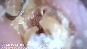 INSANE GIANT EAR WAX REMOVAL! COMPILATION | Canserbero Es vida El Indigo.