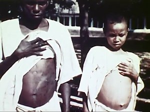 African trypanosomiasis.