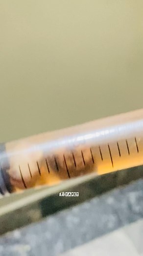 💉 Ectopic pregnancy 🤰 surgical removal of fetus from fallopian tube #ectopicpregnancy #fetus #fallopiantube | Oyapet