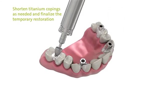 Straumann PRO Arch® - Restaurarea completa a danturii cu 4 sau 6 implanturi Straumann si dinti ficsi in 24 ore! Avantajele implanturilor dentare Straumann PRO Arch®: ✅Utilizarea unui numar redus de implanturi: de regula 4 implamturi la mandibula si 6 implanturi la maxilar ✅Implanturile Straumann sunt fabricate dintr-un aliaj extrem de rezistent de titan cu adaos de dioxid de zirconiu – Roxolid. Aceasta caracteristica permite utilizarea de implanturi cu dimensiuni mai mici, evitandu-se astfel pro