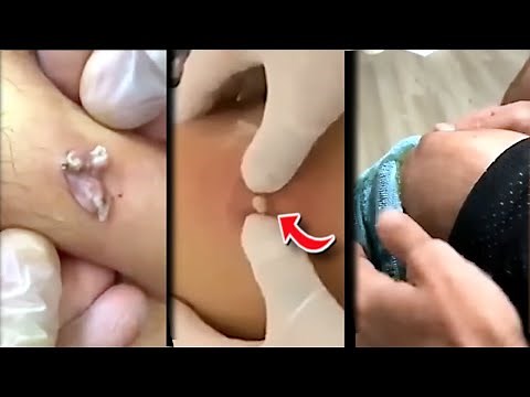 WATCH THESE PIMPLES AND BLACKHEADS EXPLODE! 😅😱