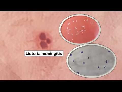 CSF Analysis in Geriatric Listeria monocytogenes Meningitis