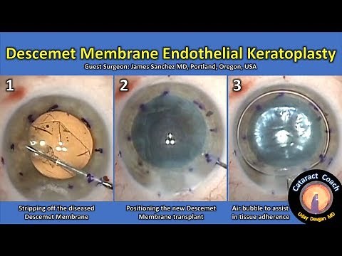DMEK: Descemet Membrane Endothelial Keratoplasty (Corneal transplant of the inner layer)