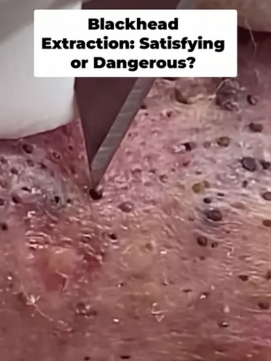 Satisfying Blackhead Extraction: Extreme Close-Ups Revealed