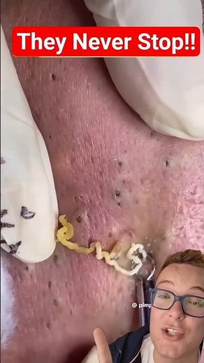 Longest BLACKHEAD REMOVAL Ever - It Just Keeps Coming #shorts