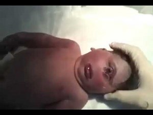 One Eye 🤨 syndrome ،cyclopia baby ,incompatible with life ,holoprosencephaly