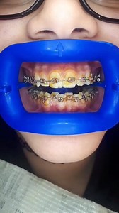 Fluoride varnish was incorporated into clinical dentistry to reduce caries; its use in the U.S. has increased progressively since it was approved by the FDA in 1994. Sodium fluoride varnish application for caries prevention, ease of application, and safety give it an advantage over other types of topical fluoride treatments (such as gels and rinses) or other caries management methods. As a result, it is regarded as one of the superior topical fluoride agents for young children. Fluoride varnish 