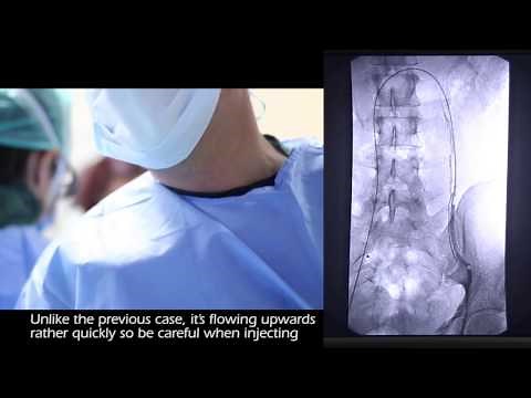 Embolization of Varicocele treatment