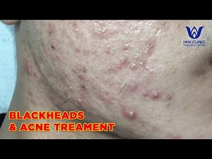 HHV Clinic | dothuhien | hienvanspa - acne removal