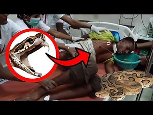 The Terrifying and Deadly Russell's Viper Snake Bite 🐍
